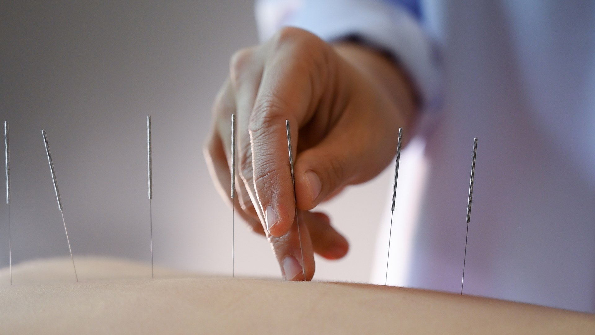 Acupuntura